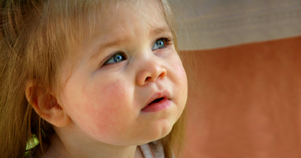 लहान मुलांना सतत येणार्‍या पुरळांमुळे होईल ‘एक्झिमा’